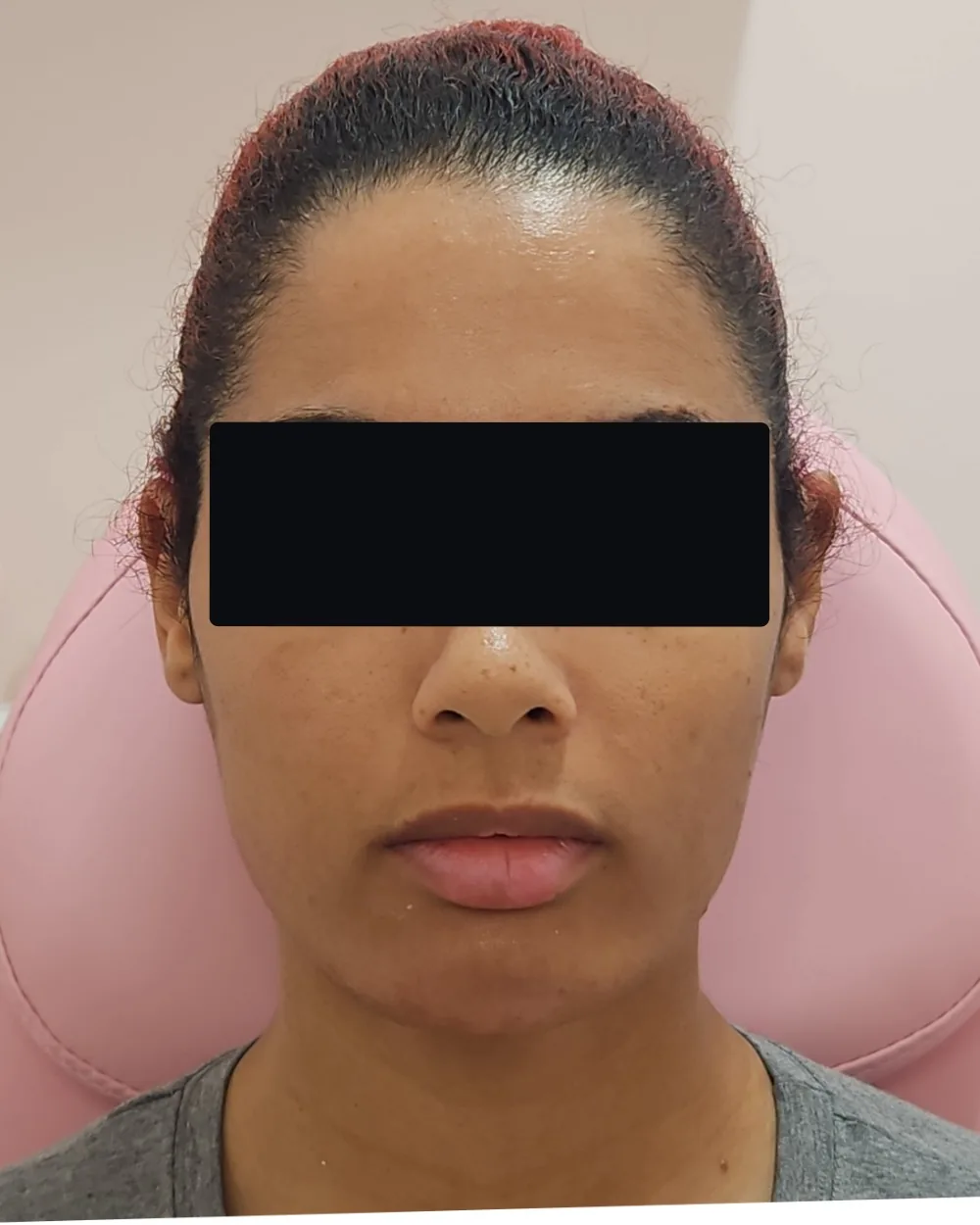 Chin Filler after treatment at USA Aesthetics in Port St. Lucie (patient case 7)