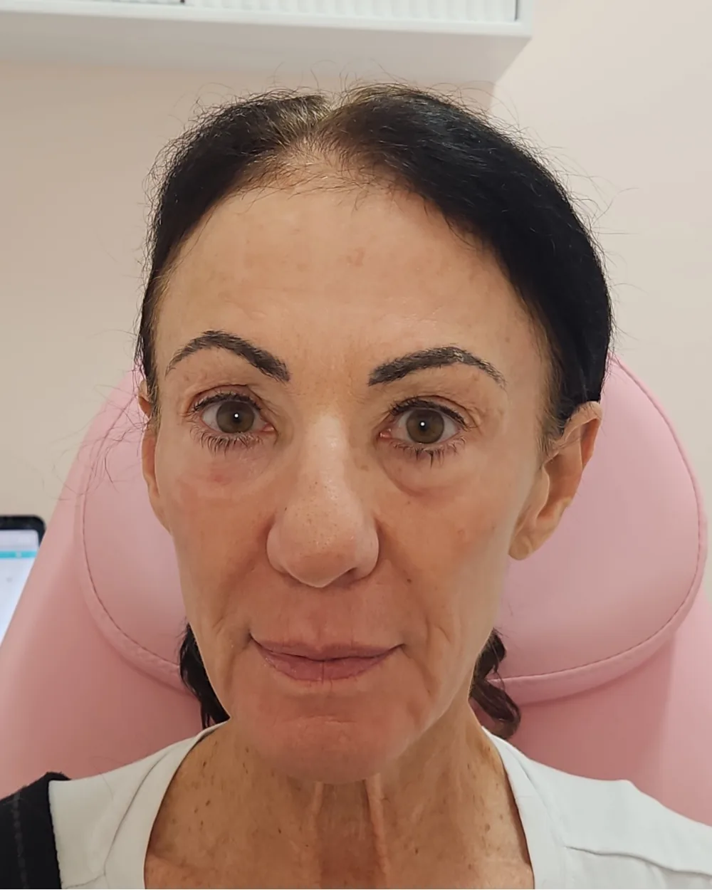 CO2 Laser after treatment at USA Aesthetics in Port St. Lucie (patient case 13)
