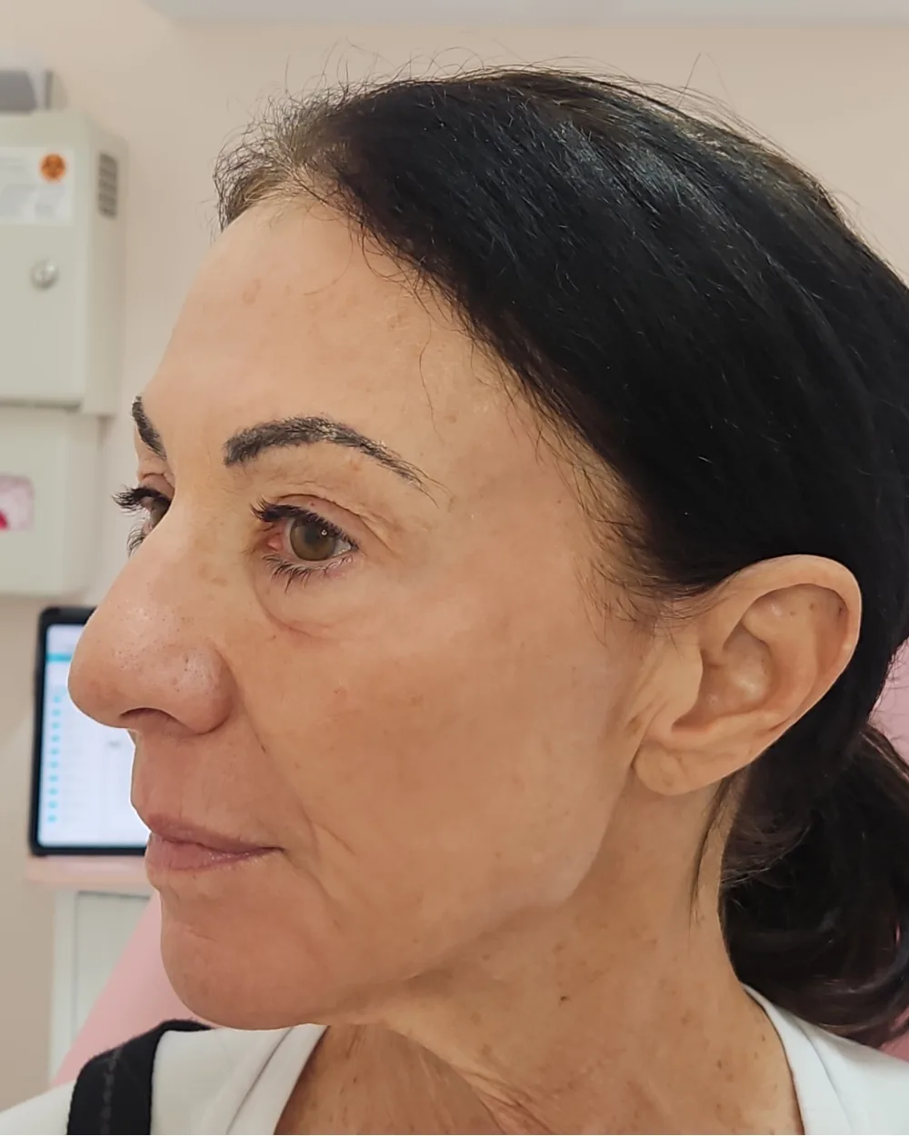 CO2 Laser after treatment at USA Aesthetics in Port St. Lucie (patient case 12)