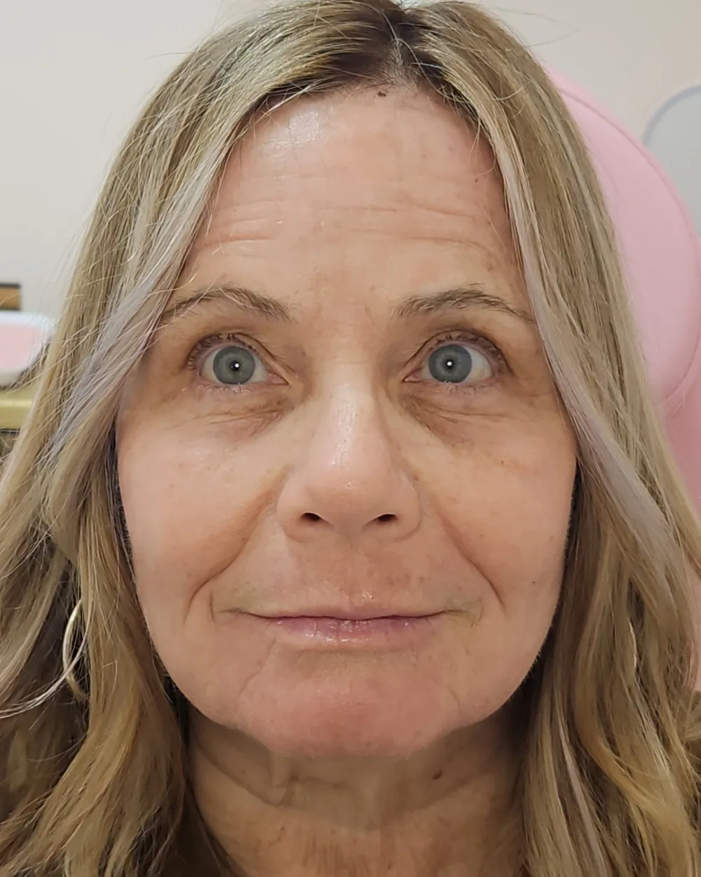 CO2 Laser after treatment at USA Aesthetics in Port St. Lucie (patient case 8)
