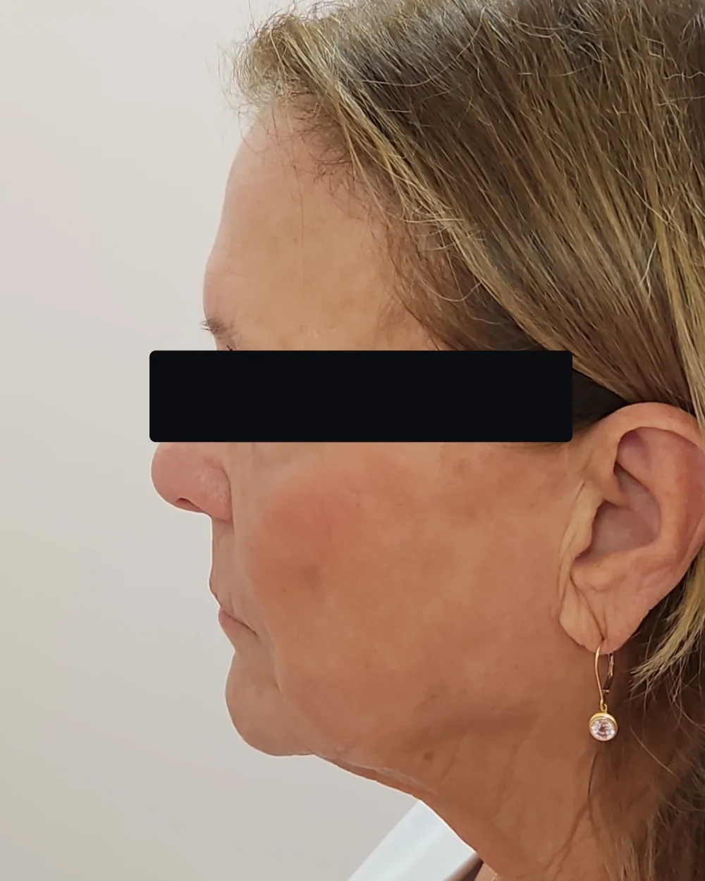 CO2 Laser after treatment at USA Aesthetics in Port St. Lucie (patient case 3)
