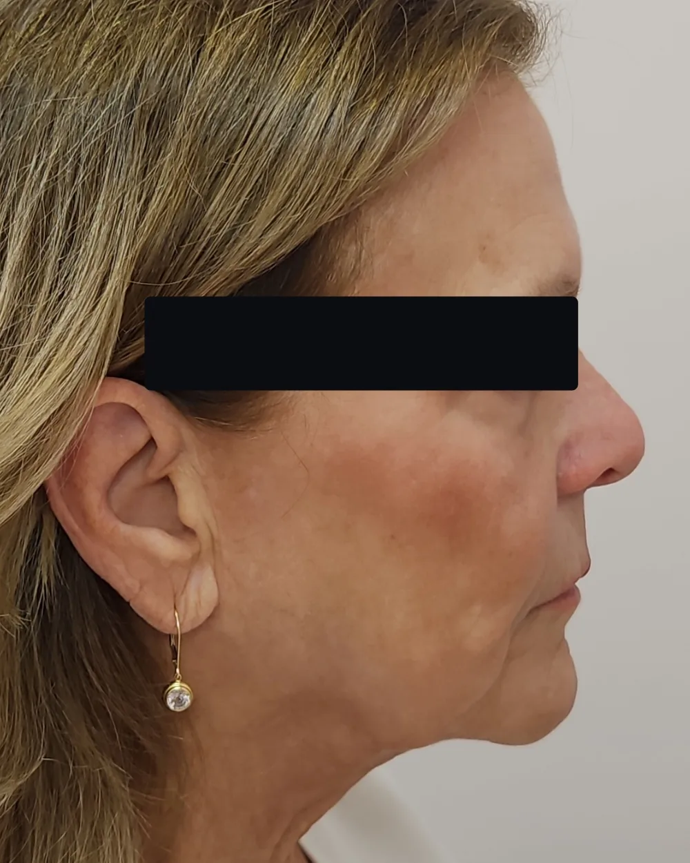 CO2 Laser after treatment at USA Aesthetics in Port St. Lucie (patient case 2)