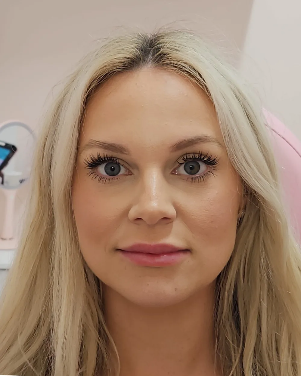Lip Filler after treatment at USA Aesthetics in Port St. Lucie (patient case 9)