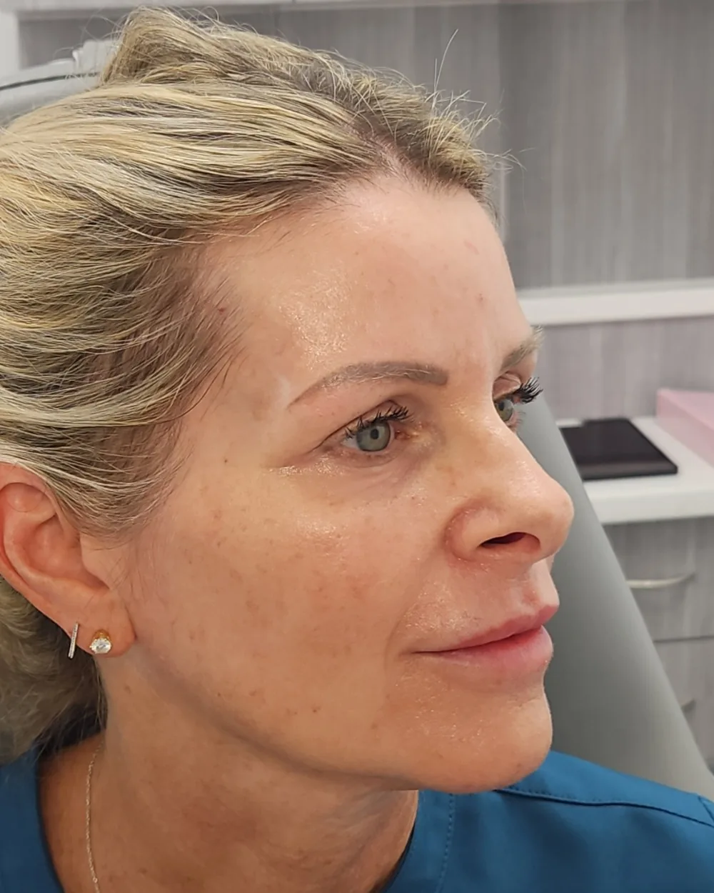 Pico Laser after treatment at USA Aesthetics in Port St. Lucie (patient case 11)