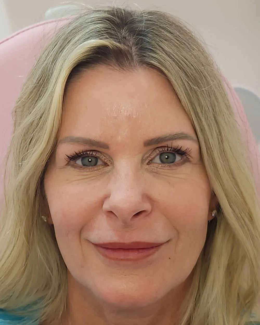 Pico Laser after treatment at USA Aesthetics in Port St. Lucie (patient case 10)
