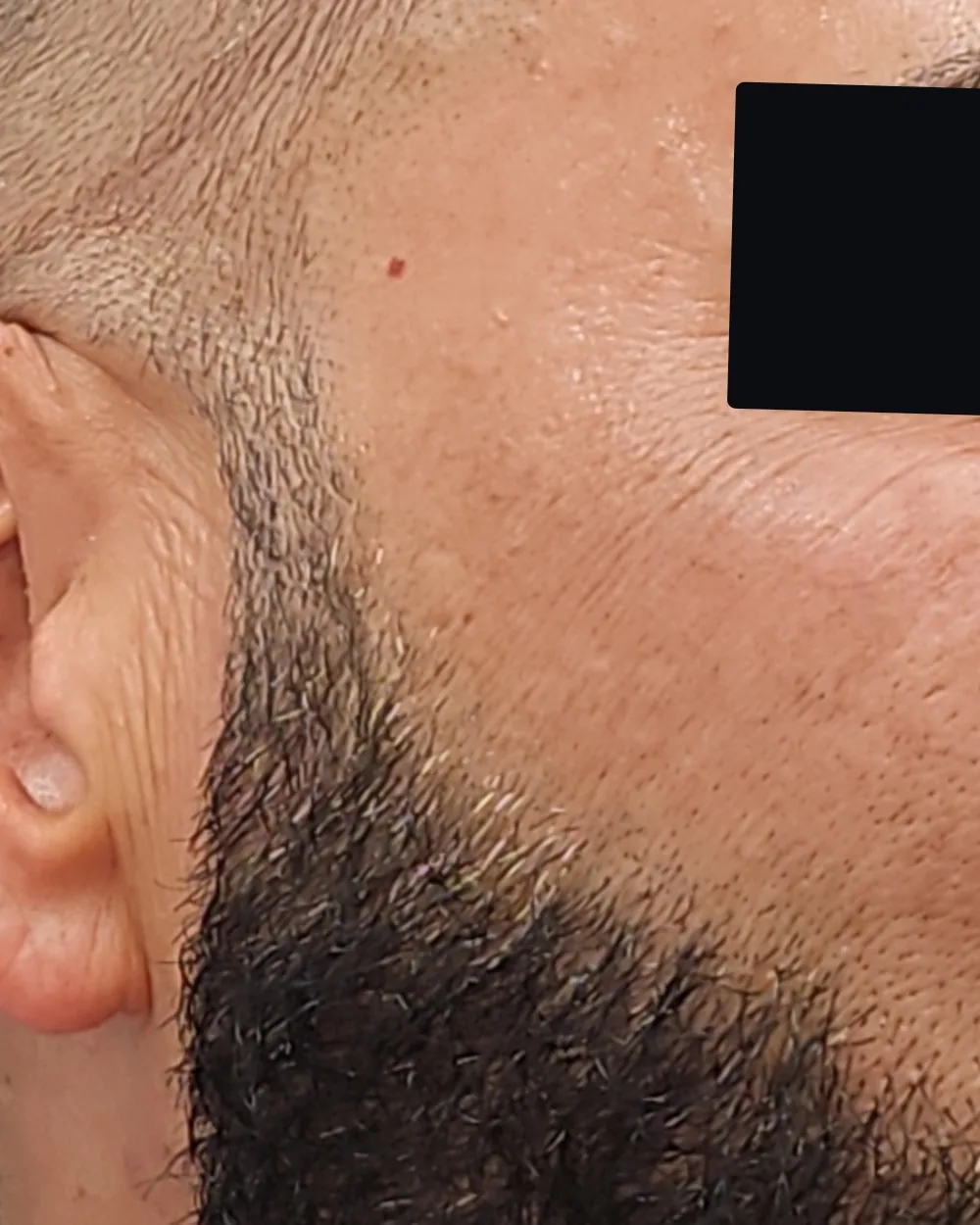 Pico Laser after treatment at USA Aesthetics in Port St. Lucie (patient case 1)