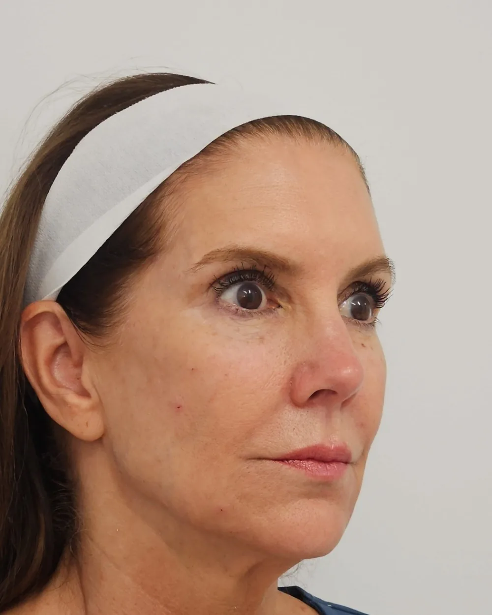 Temple, cheek, jawline and chin filler after treatment at USA Aesthetics in Port St. Lucie (patient case 4)
