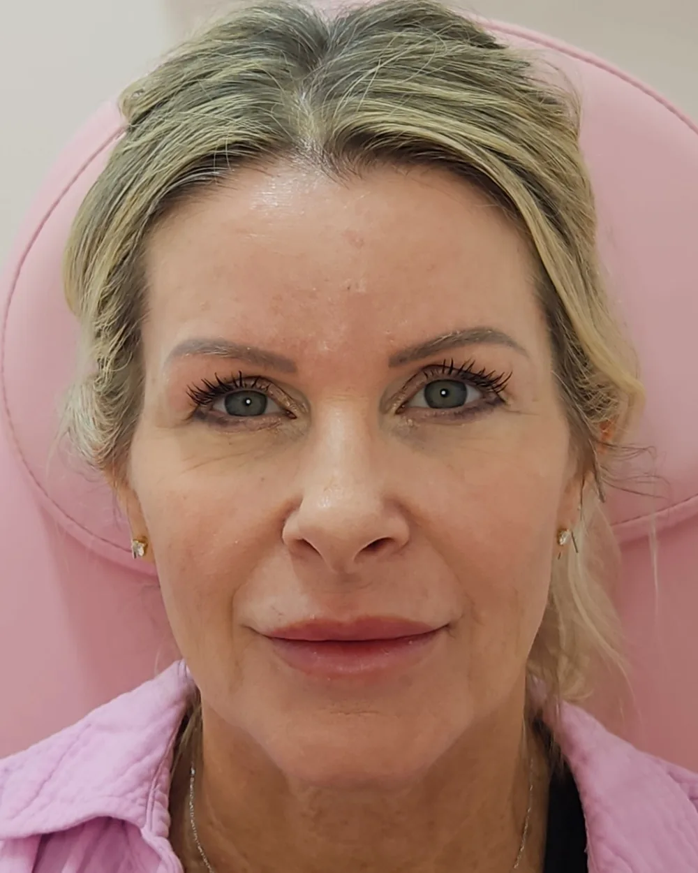 Temple filler after treatment at USA Aesthetics in Port St. Lucie (patient case 6)