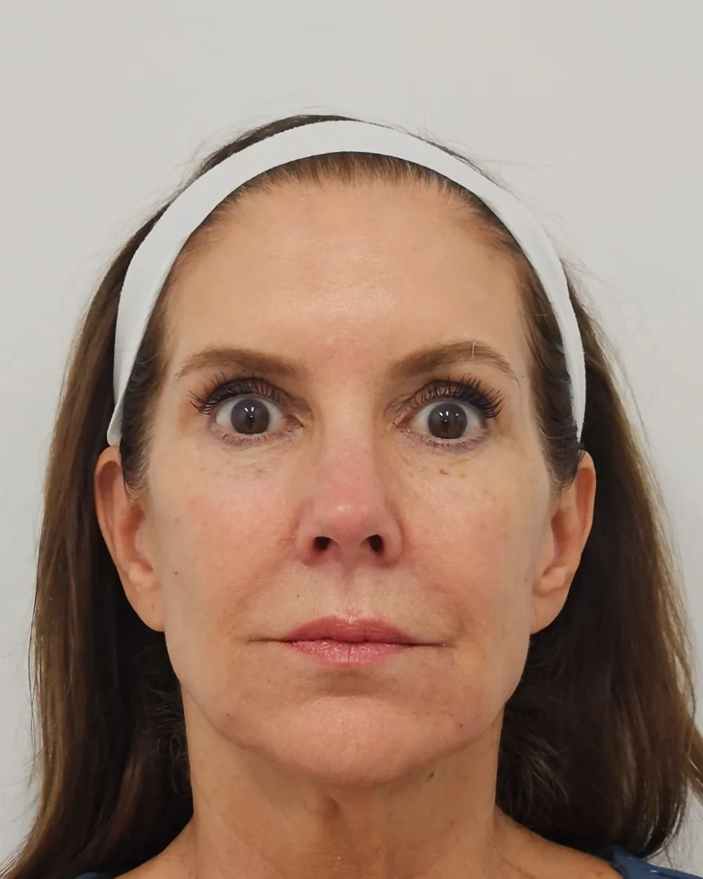Temple filler, cheek filler, pre sulcus and jawline filler after treatment at USA Aesthetics in Port St. Lucie (patient case 5)